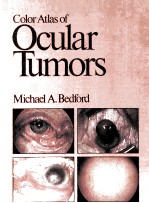 Color Atlas of Ocular Tumors