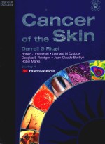 Cancer of the skin