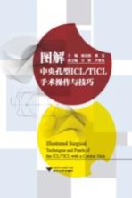 图解中央孔型ICL/TICL手术操作与技巧