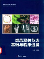 类风湿关节炎 基础与临床进展